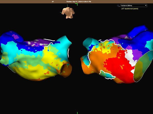 EPKatherinne's tweet photo. When an arrhythmia becomes the cause of heart failure. ⚡️
Persistent atypical atrial flutter led to tachycardiomyopathy and heart failure (LVEF 37%). The reentrant atrial tachycardia was successfully mapped and treated with catheter ablation.
#abbottproud #EP #EPeeps https://t.co/2jD8oyi7MN