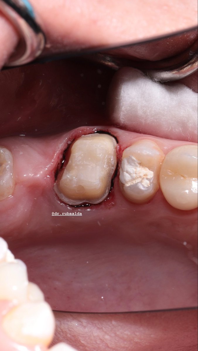 Rubaalda's tweet photo. Build-up &amp; tooth preparation for a crown

بعد بناء السن، يتم تحضيره لتركيب التاج 🦷🫧 https://t.co/5fekhPxD1H