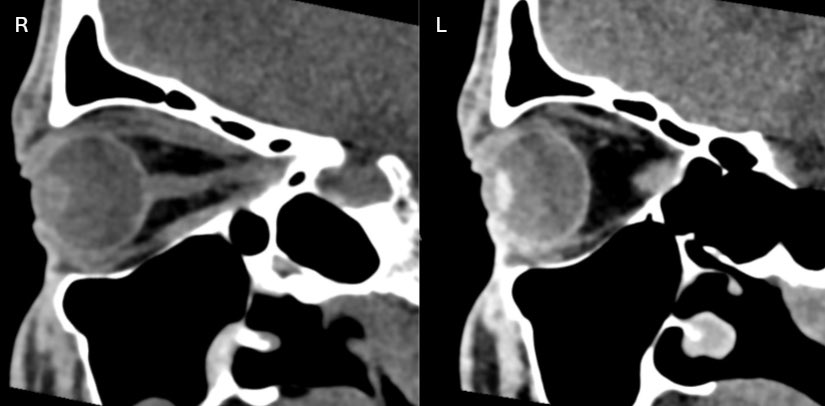 daniel_gewolb's tweet photo. ⭐️ Traumatic cataract in this patient with right eye vision loss following blunt trauma 👁️ 

🔷Imaging shows decreased density of the abnormal right lens in comparison to the left lens

🔷Damage to the lens capsule from blunt or penetrating trauma allows aqueous (watery fluid) to hydrate lens fibers lowering the density

#Ophthalmology #Neurology #trauma #Neurosurgery #ENT #MRI #Radres #Futureradres @ASHNRSociety @Radiopaedia