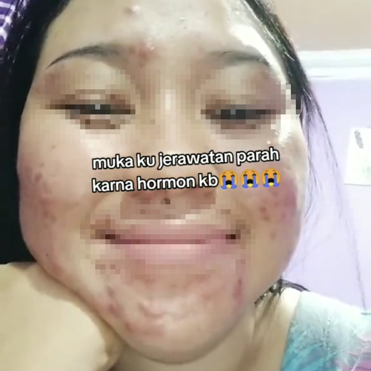 biduanssa's tweet photo. "kontrasepsi buat cowo dikaji ulang terus karena membahayakan tubuh laki-laki."

LAHHH???!!! MAKSUDNYA KB YANG DI PAKE IBU-IBU AMAN SEMUA KAH???!!!

- siklus haid gak teratur/ gak haid sama sekali
- mood swing
- muka kusam dan berjerawat
- pusing
- mual
- nyeri payudara sampe kanker payudara
- gak nafsu berhubungan badan (libido turun)
- BB naik/turun terus
- gak ngelindungi dari penyakit menular seksual
- meningkatkan resiko serangan jantung
- kanker serviks
- radang panggul dan rahim robek (IUD)
- osteoporosis
- batu empedu
- depresi berat
- nyeri hebat perut bagian bawah (IUD)