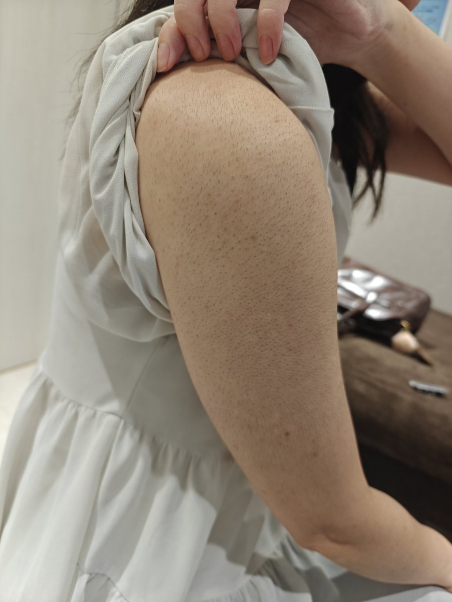 laaerartman's tweet photo. 女性の重症の硬毛化。
二の腕
太もも
前腕　全部
このレベルで硬毛化してます。
メディオスターで硬毛化スイッチが入って
そこから
ジェントルマックスプロプラスで重症化させている。

人生でいちばんお金かけたのに
残ったのは剛毛だけとのこと。 https://t.co/akhXCLmL35