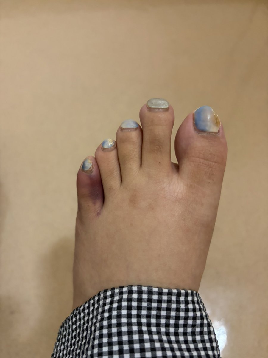 msc_ai2355's tweet photo. 今朝通勤中に足ひねって小指がえらいこっちゃに…
これやるの2回目だから分かるんだけど、たぶんヒビ入ってる💦
労災おりるって言われたから明日病院行ってくる〜 https://t.co/6kRFirJuGt