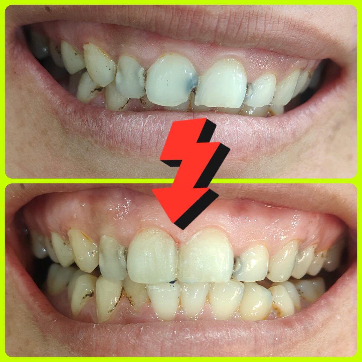 SMTDCC2010's tweet photo. 🦷 Class III Caries Treatment | Before &amp; After Composite Restoration
Yeh video upper right aur upper left dono central incisors mein Class III caries ke treatment ka before aur after result dikhata hai. 😊
Dr. Reema Khandelwal ne caries ko carefully remove karke damaged tooth https://t.co/7Pfl9993dN