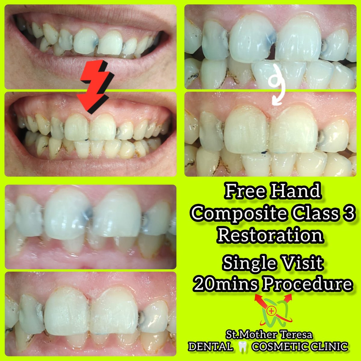 SMTDCC2010's tweet photo. 🦷 Class III Caries Treatment | Before &amp; After Composite Restoration
Yeh video upper right aur upper left dono central incisors mein Class III caries ke treatment ka before aur after result dikhata hai. 😊
Dr. Reema Khandelwal ne caries ko carefully remove karke damaged tooth https://t.co/7Pfl9993dN