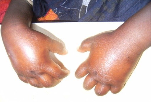 kiddiewise_'s tweet photo. We thought it was Sickle Cell Anaemia presenting with dactylitis. But this case came with a plot twist.

The Prof said, “Repeat after me: Whenever I see dactylitis, I won’t rush to conclude it’s sickle cell disease.”

This case will humble you. 👇🏽 https://t.co/Pk2NSjHn0e