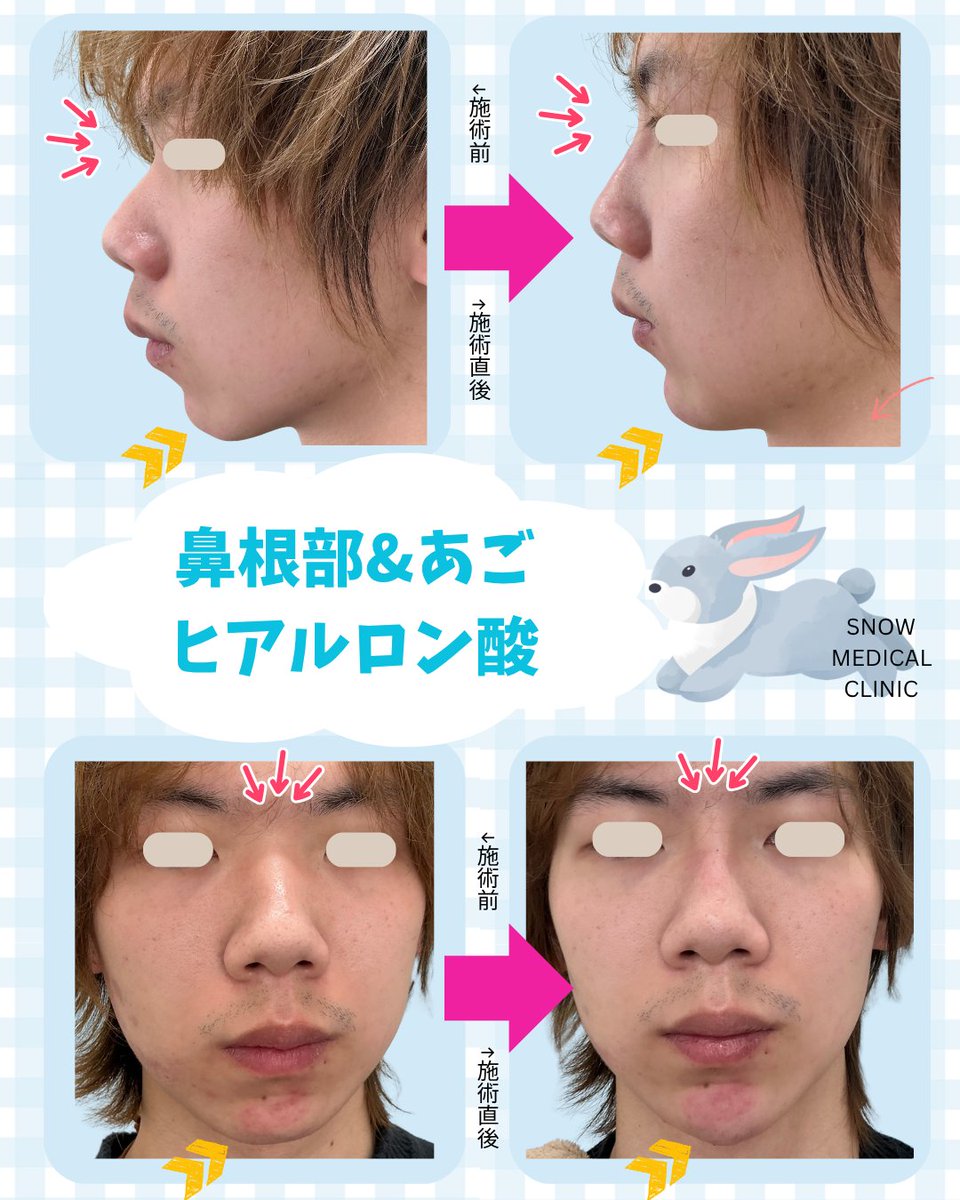SMC_tokyo's tweet photo. 港区三田・田町の美容皮膚科「SNOW MEDICAL CLINIC」です⛄️

鼻根部＆あごにヒアルロン酸を注入した症例をご紹介✨

鼻筋を整え、あごに自然な立体感をプラスすることで、横顔の印象もすっきり。

#ヒアルロン酸 #鼻ヒアル #あごヒアル #横顔美人 #美容皮膚科 https://t.co/G9hvNbNY4j