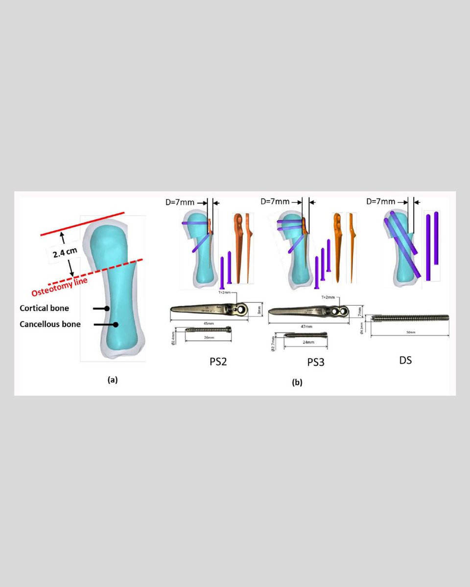 BoneJointRes's tweet photo. Mini-plate fixation demonstrated superior resistance to bending-induced micromotion compared with dual-screw fixation in distal metatarsal osteotomy.
#Biomechanics #HalluxValgus #Bunion
https://t.co/YzHBEen8y8 https://t.co/LB4myveTi2