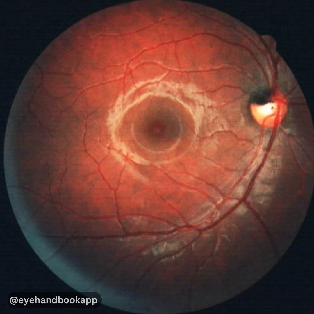 EyeHandbook's tweet photo. What is this optic disc lesion?
Check ALT for more info.
#ophthalmology #optometry #optometrists #eyecalculators #clinicalcalculators #eyecare #eyesight #ophthalmologyresidents #optometrystudents #eyesurgery #optometrystudent #eyedoctor #eyehealth #eyes https://t.co/0F0SYZoAjR