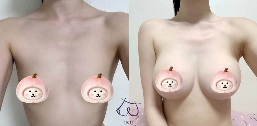 _unups's tweet photo. 🧑🏻‍⚕️ソ院長先生
💜メンターエクストラ

自然なボリューム感と美しいバストラインへ🪄

一人ひとり異なる体型や骨格、バストの形・左右差などを考慮しながらデザインしていきます😉✨

バスト全体に自然なボリュームをプラスしながら、
デコルテからバストまで女性らしい柔らかなラインへ💜 https://t.co/aO2gTpdPrG