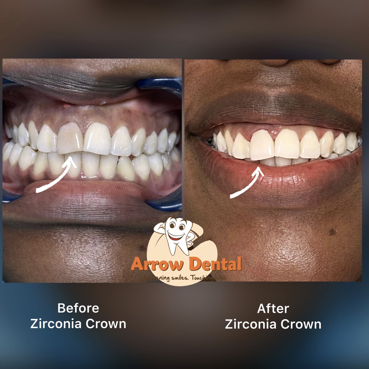 Arrow_Dental's tweet photo. After root canal treatment, a tooth may sometimes discolour because it is no longer receiving blood supply. 🦷

We used a zirconia crown to restore its colour, shape and strength — beautifully, of course. 🤍

📲0119384741 | 0740187579

Make that call today.

#arrowdental https://t.co/6JcCqWkmFi