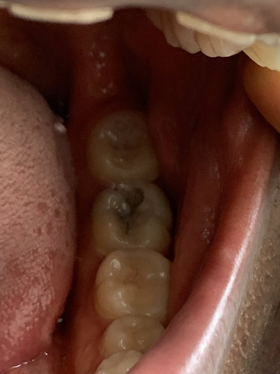 Dahveed_D's tweet photo. @cindy_blog I’m in severe pain, I need to remove the tooth please. It will go a long way for the removal and medication, please 🙏 🙏 https://t.co/kqMuNdcQW9