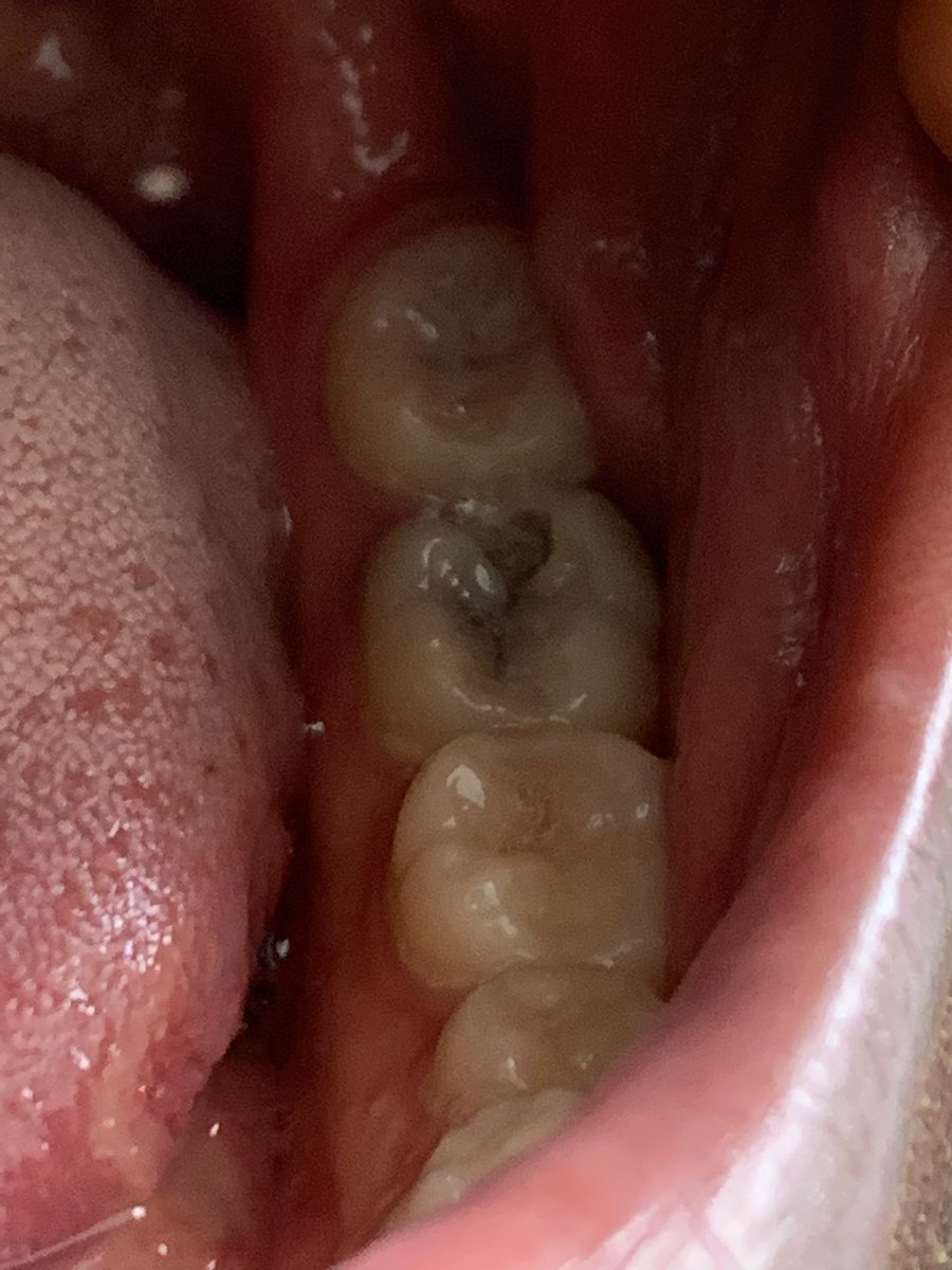 Dahveed_D's tweet photo. @cindy_blog I’m in severe pain, I need to remove the tooth please. It will go a long way for the removal and medication, please 🙏 🙏 https://t.co/kqMuNdcQW9
