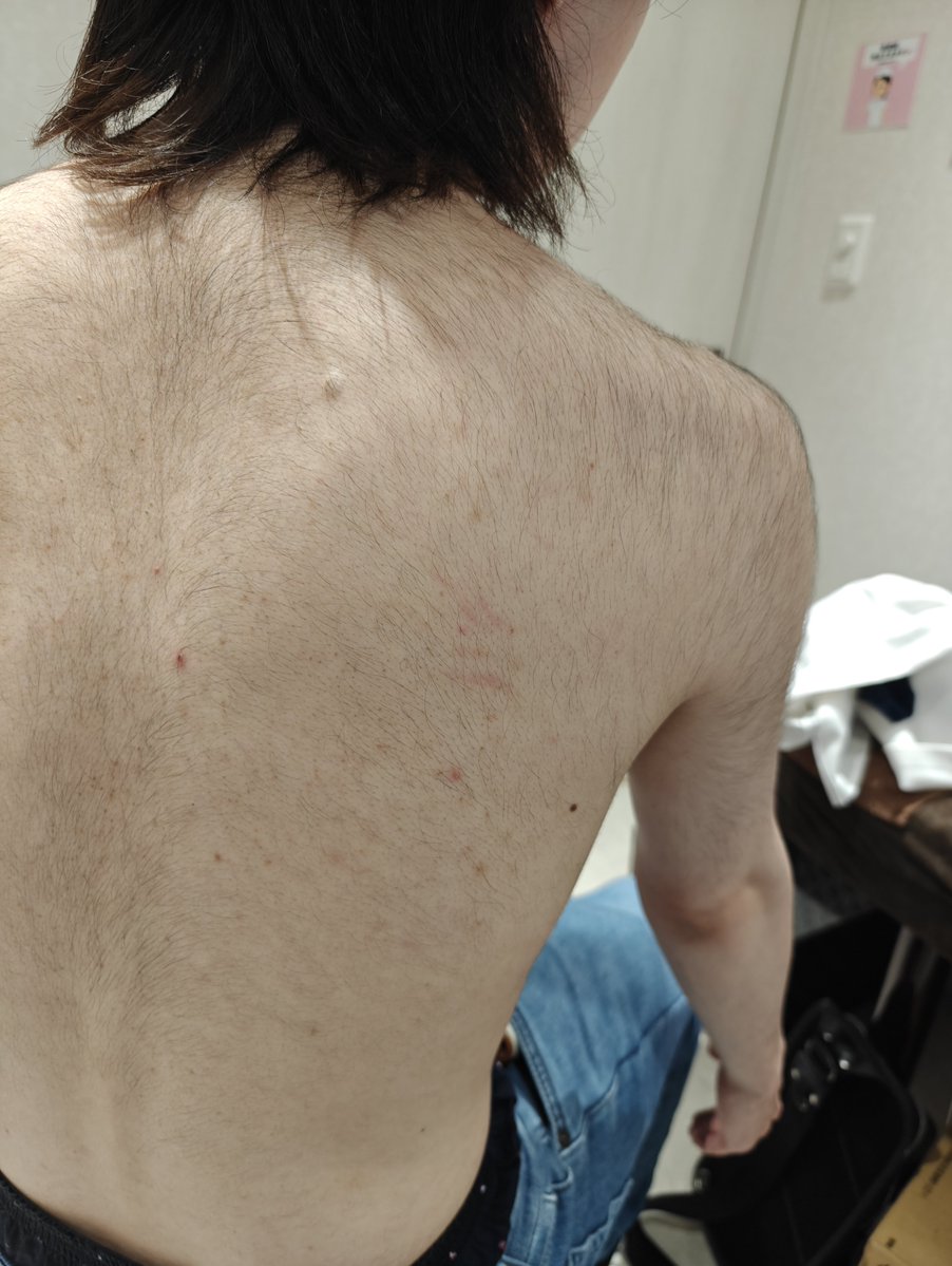 laaerartman's tweet photo. 脱毛に70万払って
こんな硬毛化してしまう若者。
可哀想すぎる。
硬毛化させたクリニックはテンプレ対応しかしないらしい。
さすがに可哀想である。
うちで無料で硬毛化レーザーで治療。
さすがに
お金取れないよ。
やればやるほど赤字ですよ
(;´д｀)ﾄﾎﾎ… https://t.co/duQYrDgk4o