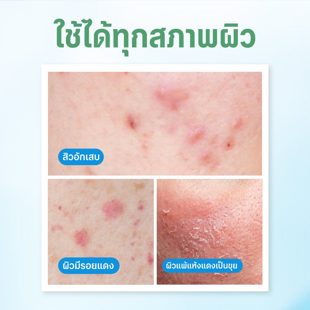 merci_skincare's tweet photo. ซองนี้แหละ! ตัวช่วยจบลูปสิว & ผิวอ่อนแอ 
เพราะผิวที่เป็นสิวบ่อย ต้องการการดูแลมากกว่าเดิม

รวมตัวเก่งเพื่อผิวแข็งแรงไว้ครบ!
🍵 Matcha Postbiotic
💧 Panthenol B5
✨ Niacinamide 2%
🛡️ Ceramide Complex

ช่วยรีเซ็ตสมดุลผิว ลดรอยแดง
พร้อมเสริมเกราะป้องกันผิวให้แข็งแรงขึ้น 💪

ชุ่มชื้นยาวนานถึง 120 ชม.
ใช้ได้ทุกสภาพผิว แม้ผิวแพ้ง่าย

💚 ซองละ 59.-
📍 ช้อปได้แล้วที่ 7-Eleven ทุกสาขา

#MerciSkincare #เมอร์ซี่สกินแคร์ #MercixNuNew #เซเว่น #ครีมซองเซเว่น #ผิวชุ่มชื้น #ผิวโทรม #มอยส์มัทฉะB5
