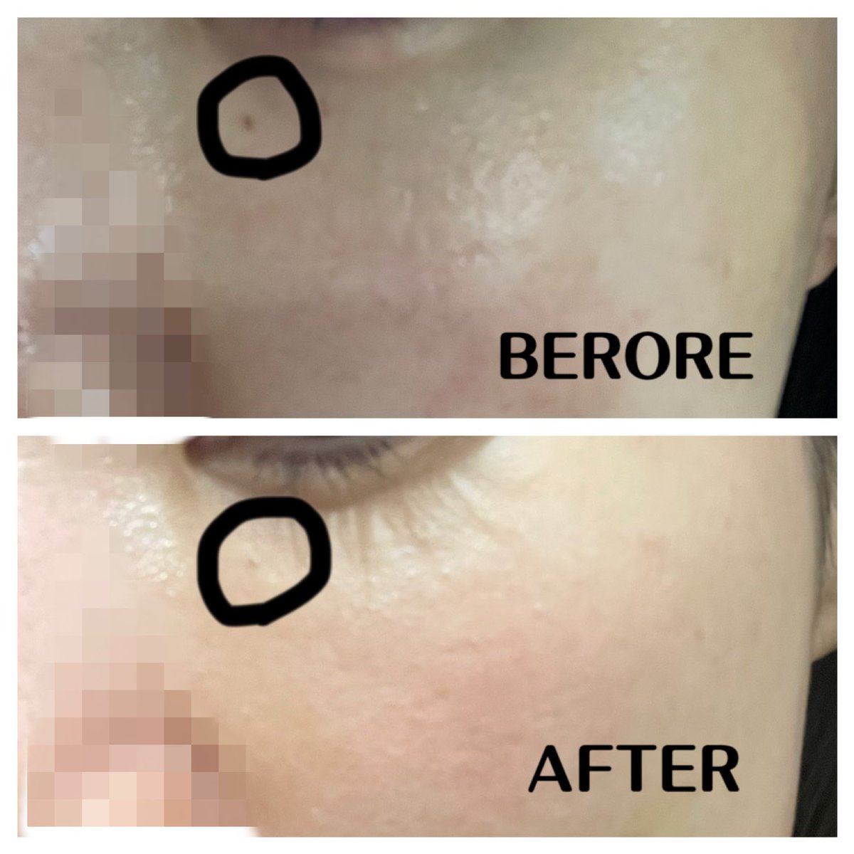 🇰🇷ディアブクリニック(@diavclinic)
・トリプルトーニング+イオン導入
☝️代表院長が肌めっちゃ見てくれて、合ったレーザー3つ選んでもらえる(楽しい)
私はシミはほとんどないけど、ニキビ跡と赤みがあるということで、
・ピコトーニング
・ジェネシス
・赤み、くすみ取りレーザー(クラリティⅡ)
を打ってもらいました!
赤みにはジェネシスが効くらしい👍
ピコトーニングとジェネシスはショット数多め!
スポットでほくろに打ってもらったところは、1回濃くなってポロって取れて薄くなった🙌
明洞駅出口目の前で、平日は最終19時まで受付してくれるから観光メインの方も行きやすいと思います☺️
🏥ディアブクリニック @diav_clinic_JP
📍明洞駅5番出口より徒歩1分
⏰営業時間
月曜日~金曜日:午前10時~午後8時
土曜日~日曜日:午前10時~午後4時半
施術提供
#DIAVクリニック #韓国