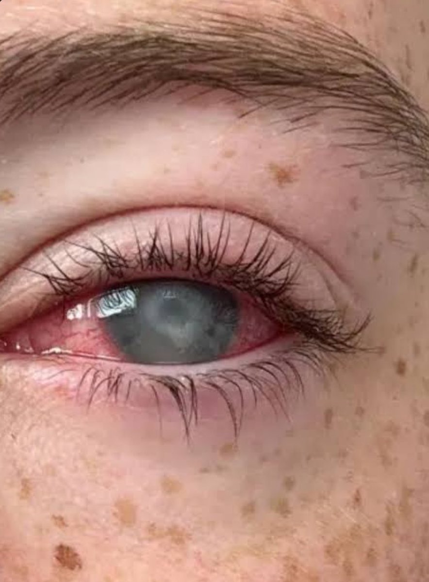 choquei's tweet photo. 🚨URGENTE: Jovem fica cega após hábito de tomar banho com as lentes de contato: “Antes disso acontecer, ninguém nunca tinha me dito que não pode.” https://t.co/gfAdFiIR2r