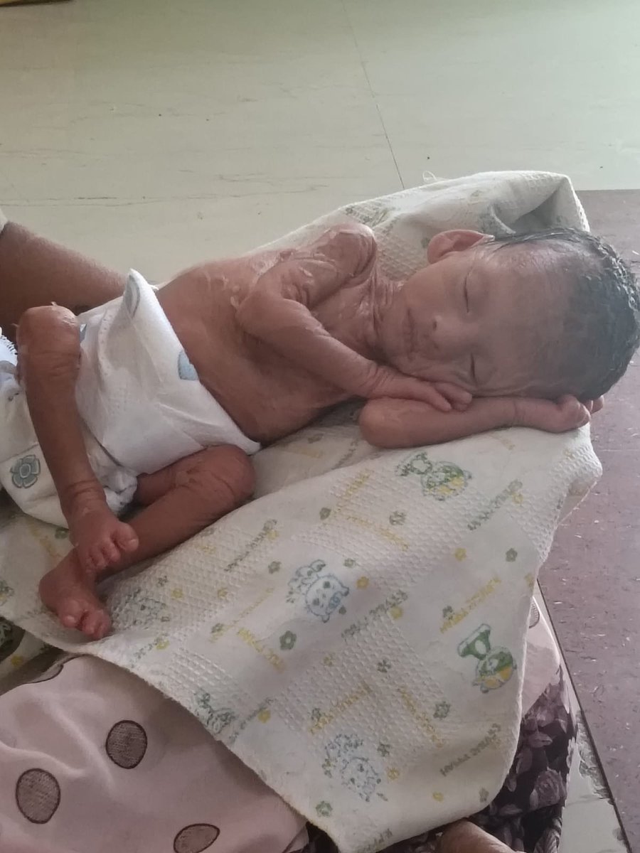 IAMAdityaTweet's tweet photo. ஒரு 3வருஷம் முன்னாடி எங்க அக்கா பையனுக்கு இப்படி இருந்துச்சு இப்ப எங்க மாமா மகன் க்கு பொறந்த குழந்தை இப்டி பிறந்து இருக்கு என்ன பிரச்னை எங்க relative ல இது 4th baby இப்படி பிறந்து இருக்கு 🙄🙄🙄🥹🥹  உடம்பு fulla தோல் உரியுது குழந்தை அழுகுது இதை காப்பாத்த முடியாதா?? #Help 🙏 https://t.co/zuYwQ8xEdp