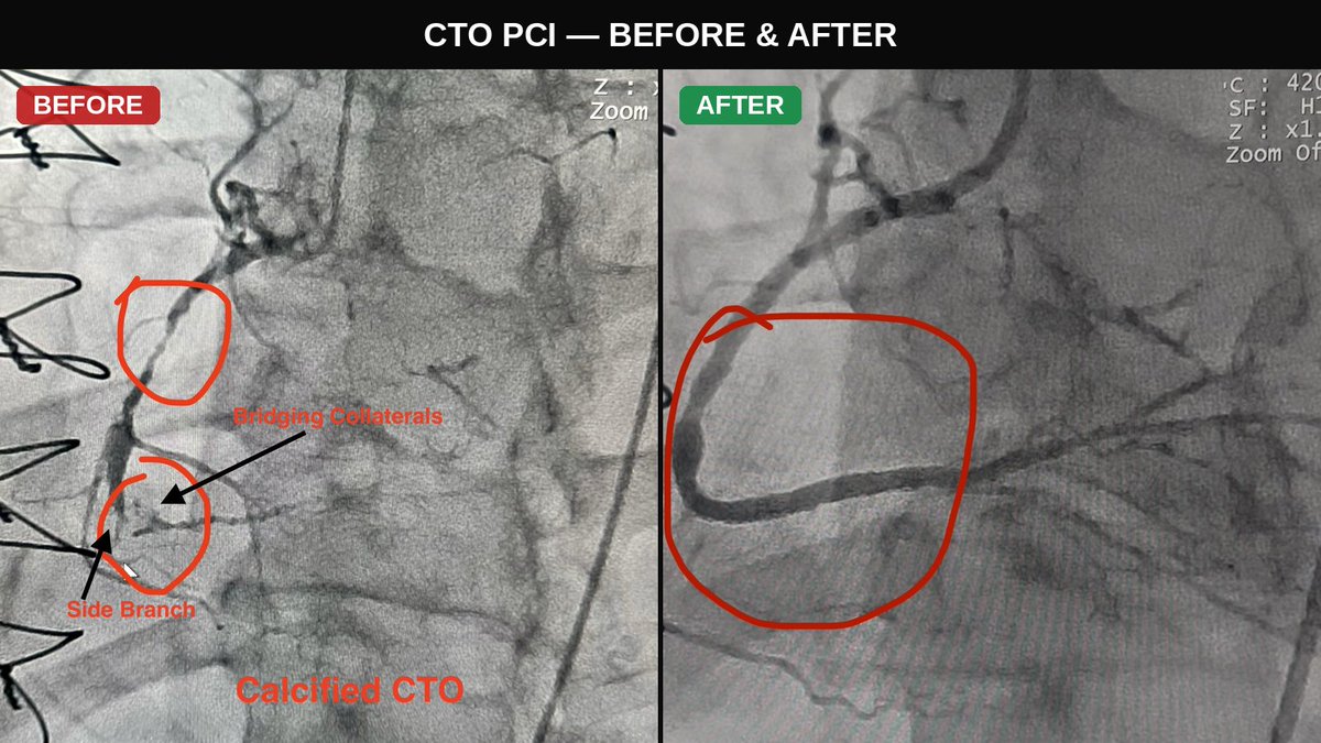 arnavkumar's tweet photo. When the #CTO cap says no, & the side branch says yes: fighting wire bias on an angulated, calcified occlusion.

Prior CABG, refractory #angina, PET showing reversible #ischemia in the RCA territory.

One case, multiple techniques — learnt from mentors, colleagues, and friends.

#CTO #CTOPCI #CABG #ADR #HDR #Atherectomy
#CardioTwitter #MedED #MedTwitter

@Murmur_MD @DLBHATTMD @HadyLichaaMD @YChatzizisis @iamritu @CASivaram1 @purviparwani @Pooh_Velagapudi