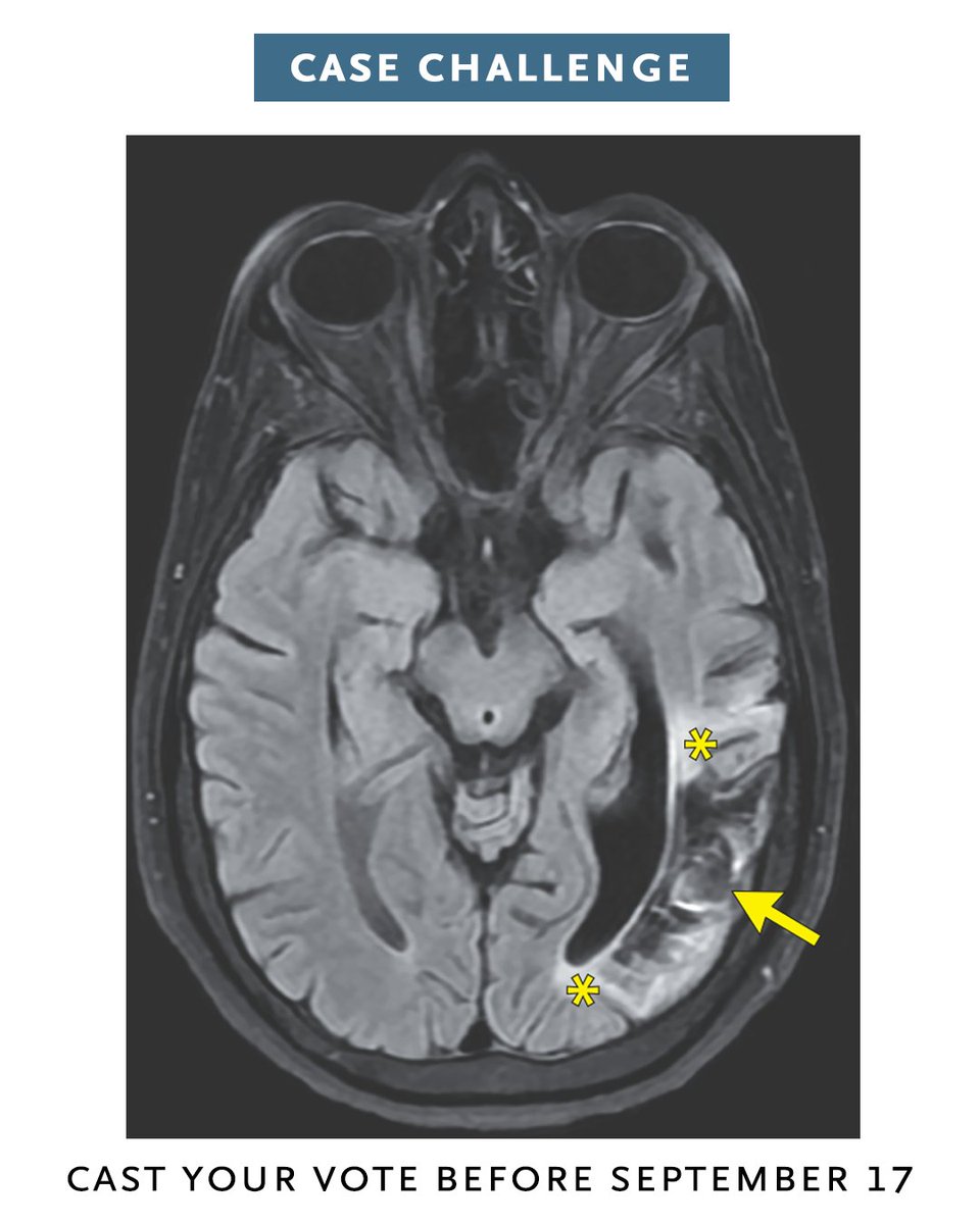 NEJM's tweet photo. A 62-year-old woman with a history of stroke and metastatic breast cancer that was being treated with immunomodulator therapy presented with memory loss, confabulation, anhedonia, ataxia, and weight loss. What is the most likely diagnosis?  

Read the case details and vote: https://t.co/Fh7tYtpgVX 

#Neurology