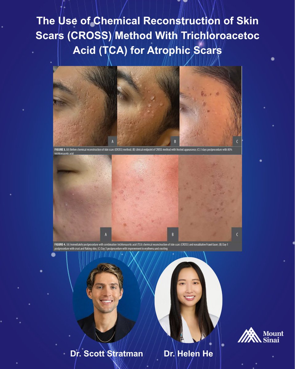 MSHSDerm's tweet photo. A new review by Dr. Scott Stratman &amp; Dr. Helen He examine TCA CROSS for atrophic scars, highlighting its efficacy for acne scarring and its role alongside combination treatments. Details: 📖 https://t.co/VDNvEND2Fz #Dermatology @EmmaGuttman https://t.co/Z2DKrfedny
