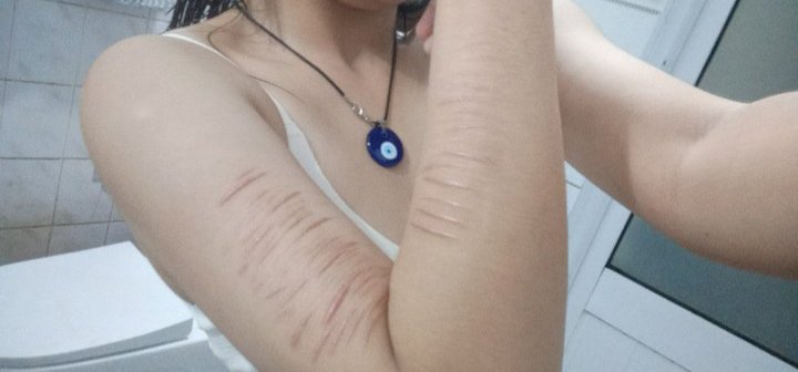 dgh0407's tweet photo. #sh #scars https://t.co/mypuldoKPt