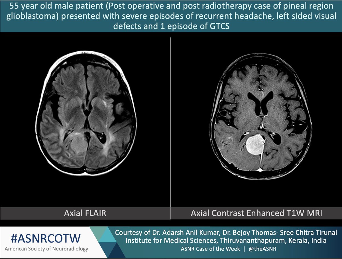 TheASNR's tweet photo. ASNR COTW # 311

Hx: 55 year old male s/p glioblastoma resection and RT with severe recurrent headache, left sided visual defects

NO SPOILERS! Give hints in the form of GIFs or answer poll. Answer in 24 hours.  

#neuro #neurorad #radres #FOAMed #FOAMrad #medtwitter #ASNRCOTW https://t.co/Wrz2gWWf71