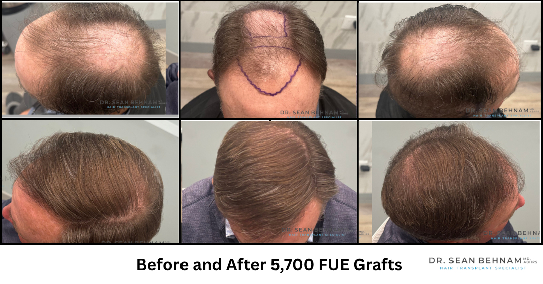 IGetHair's tweet photo. Megasessions - 5,700 FUE Grafts from the midscalp to the hairline by Dr. Sean Behnam
#HairTransplant #FUE #FUEHairTransplant #HairRestoration #HairTransplantResults https://t.co/rfPbYLczBf