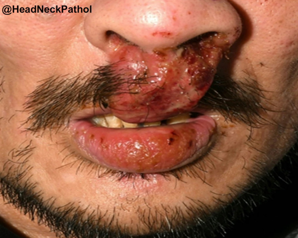HeadNeckPathol's tweet photo. Cocaine-Induced Plasma Cell Dermatomucositis (CI-PCDM): Clinical and Histopathological Features of a UK Cohort
G Thermos, E Morrison, L Cuddy, et al.
https://t.co/U0pGCNk8HS
#HeadNeckPathol #HNPJ #HeadandNeckPath #Pathology #ENTPath #PathologyTweet https://t.co/rFOU4Ml3kA
