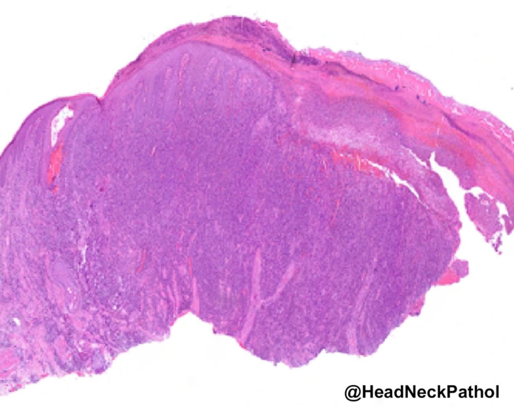 HeadNeckPathol's tweet photo. Cocaine-Induced Plasma Cell Dermatomucositis (CI-PCDM): Clinical and Histopathological Features of a UK Cohort
G Thermos, E Morrison, L Cuddy, et al.
https://t.co/U0pGCNk8HS
#HeadNeckPathol #HNPJ #HeadandNeckPath #Pathology #ENTPath #PathologyTweet https://t.co/rFOU4Ml3kA