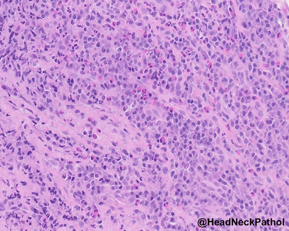 HeadandNeckPath's tweet photo. Cocaine-Induced Plasma Cell Dermatomucositis (CI-PCDM): Clinical and Histopathological Features of a UK Cohort
G Thermos, E Morrison, L Cuddy, et al.
https://t.co/TuWzcFU7OW
#HeadNeckPathol #HNPJ #HeadandNeckPath #Pathology #ENTPath #PathologyTweet https://t.co/SNGkyMsQjs
