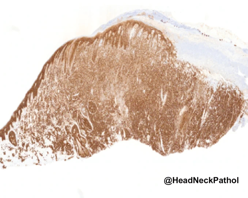 HeadandNeckPath's tweet photo. Cocaine-Induced Plasma Cell Dermatomucositis (CI-PCDM): Clinical and Histopathological Features of a UK Cohort
G Thermos, E Morrison, L Cuddy, et al.
https://t.co/TuWzcFU7OW
#HeadNeckPathol #HNPJ #HeadandNeckPath #Pathology #ENTPath #PathologyTweet https://t.co/SNGkyMsQjs