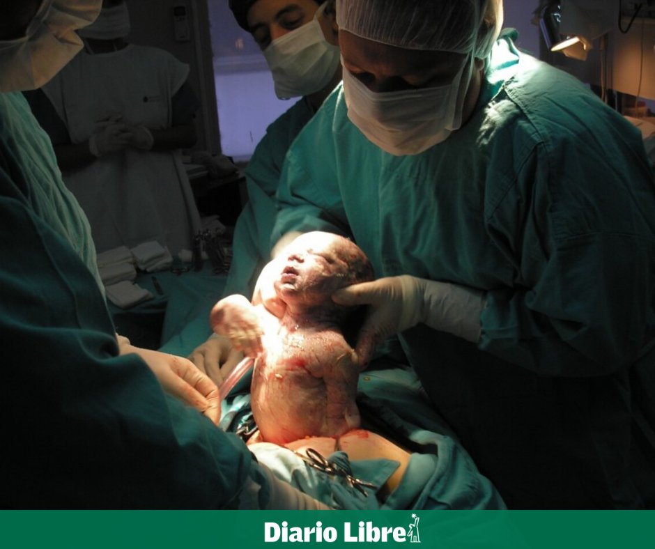 DiarioLibre's tweet photo. ⚕ |#SaludDL| Sociedad de Obstetricia sobre la alta tasa de cesáreas en RD: "ha rebasado el límite"
¿Cuáles riesgos aumentan con las cesáreas repetidas?
https://t.co/nKKEm4Xuf2
#DiarioLibre #Cesáreas #SociedaddeObstetricia #Partos #Unicef https://t.co/dnymNz1Ts5