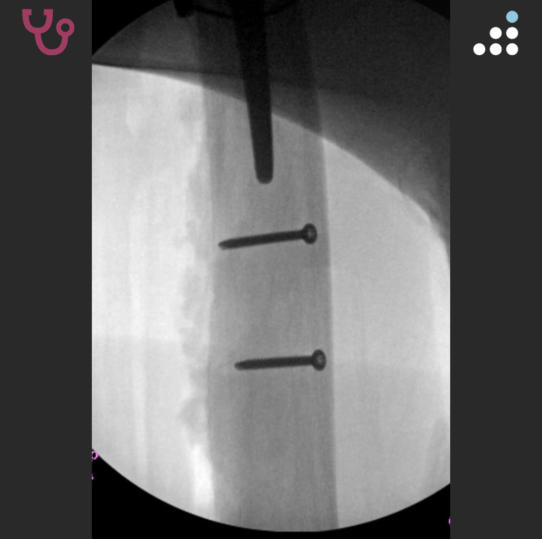 orthobullets's tweet photo. Here are the intraoperative images. https://t.co/r3vy0fEAoL