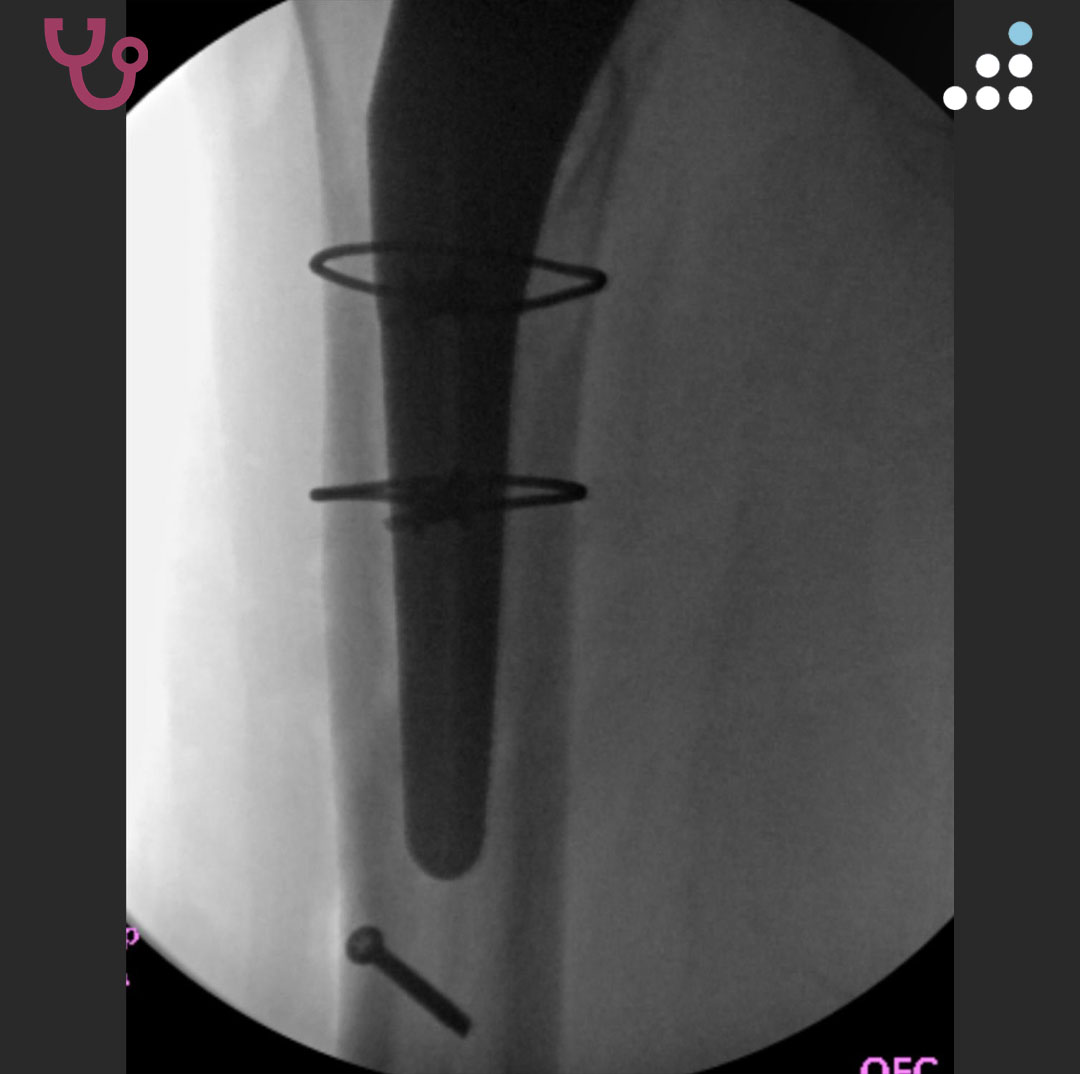 orthobullets's tweet photo. Here are the intraoperative images. https://t.co/r3vy0fEAoL