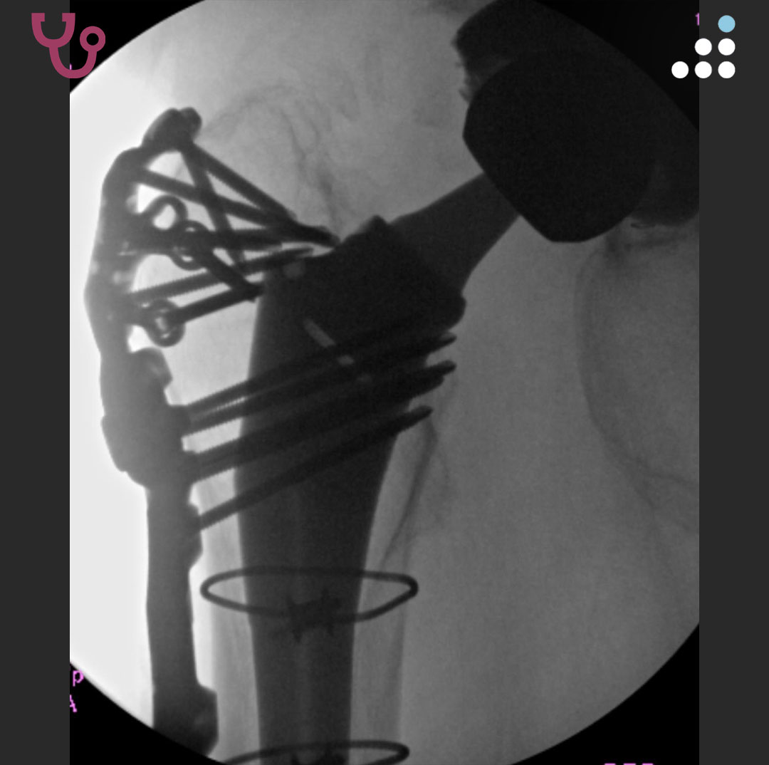 orthobullets's tweet photo. Here are the intraoperative images. https://t.co/r3vy0fEAoL