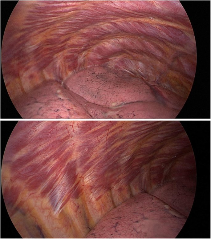 drMhashim95's tweet photo. كل مرة بدخل
 Open heart surgery 
لازم افضل سرحان دقايق في المنظر ده
القلب اللي بيدق  آلاف المرات في اليوم
بكهربية منتظمة بشكله المميز و انسجته المميزة أنه يفضل ينقبض وينبسط على مدار السنين

الcoronary arteries  وحجمها الصغير اللي مش هتعرف تشوفها كويس بدون loupe 
ولو حصل فيها  انسداد 
الإنسان بيعاني وممكن يتوفى

والChest wall muscles 
اللي تحسها مرسومة في نسق جميل جداً
 
علشان كده مستحيل أقتنع أن كل التعقيد والجمال ده وُجد بلا هدف وعن طريق طفرات عشوائية غير مُخطط ليها حتى

سبحان الله
" إنا كل شيء خلقناه بقدر "