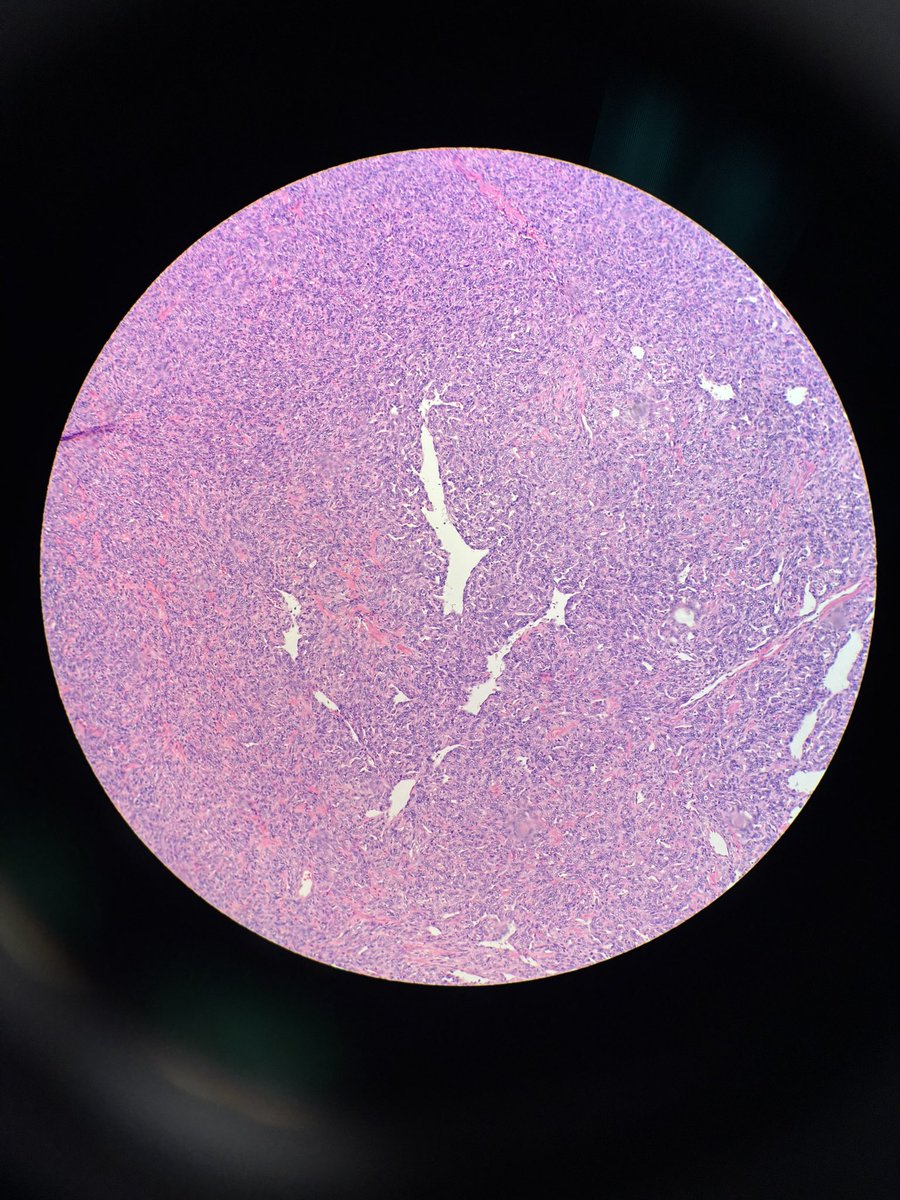 CytoPapGuy's tweet photo. Gorgeous staghorn pattern! What molecular test confirms this diagnosis? 

#pathology #cytopath #cytopathology #pathologyresidency #medicalresident #medschool https://t.co/mo0ouscNg9