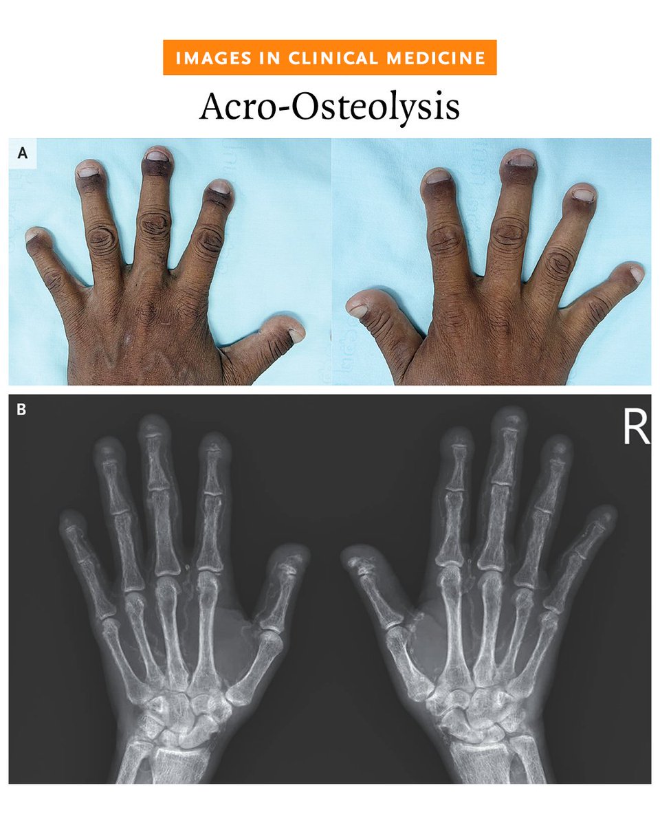 NEJM's tweet photo. A 46-year-old man with CKD presented with a 2-year history of painless shortening and rounding of the fingertips. Radiographs of the hands showed resorption of the terminal tufts of all the distal phalanges. 

Read the full case details in the Images in Clinical Medicine article “Acro-Osteolysis”: https://t.co/GUGeiAZvfe