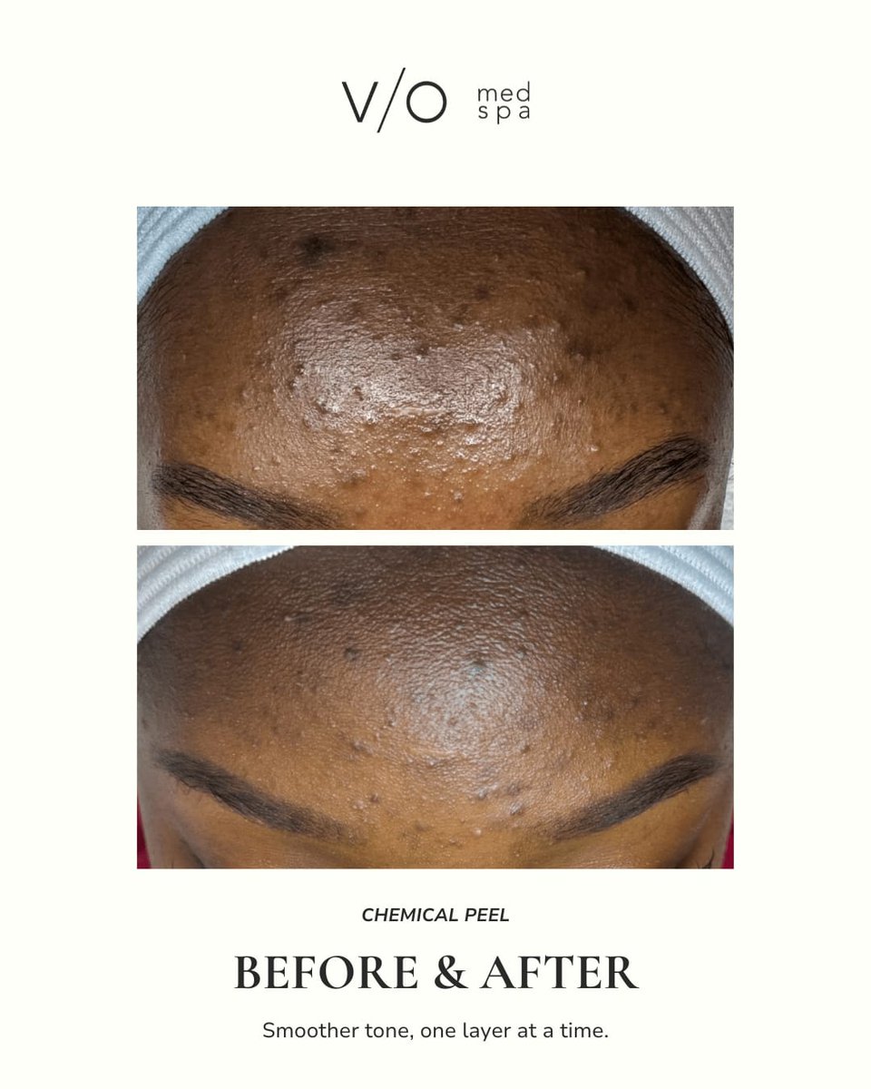 VIOMedSpaFM's tweet photo. The reset is not about starting over. It is about choosing the right next step.

This chemical peel before and after shows visible improvement in uneven tone and texture.

Individual results vary.

#ChemicalPeel #FortMyersSkincare #VioMedSpaFortMyers https://t.co/wLcUZe6ium