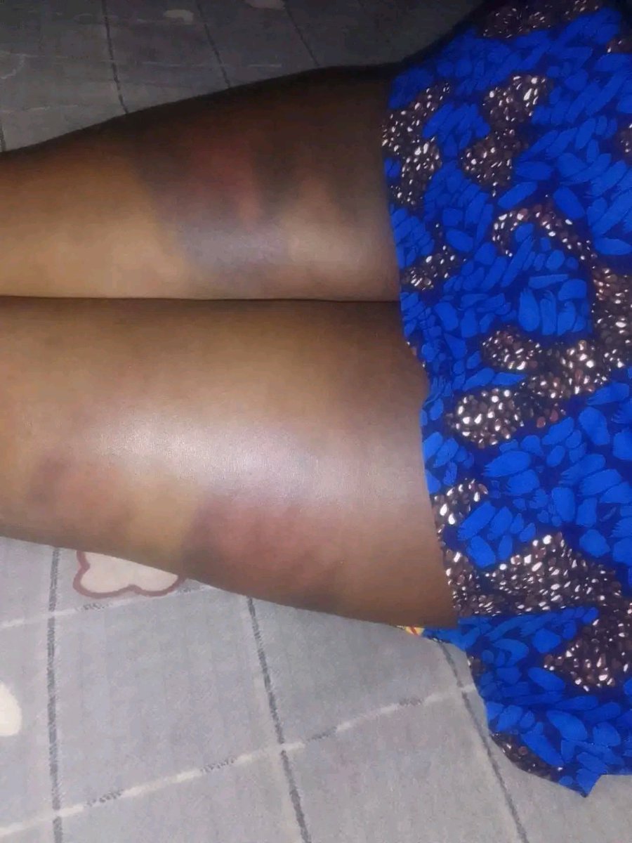 BurningOpiyo's tweet photo. 🚨 THIS IS DEEPLY DISTURBING.

A student from Bungoma is reportedly fighting for her life after allegedly being beaten by her school principal.

Let that sink in.

A STUDENT. A CHILD. Allegedly beaten by the very person entrusted with her care and protection.

Schools are supposed to be safe spaces where children learn, grow and build their futures.

Not places where a child allegedly leaves with injuries serious enough to put her life at risk.

If these allegations are confirmed, then this cannot simply be dismissed as “discipline.” There must be a thorough investigation, and anyone found responsible must face the consequences.

The most important question right now is simple:

Will this child survive, and will justice be served?

We cannot normalize violence against children.

We cannot look away.

We cannot wait for another tragedy before demanding accountability.

Authorities must urgently establish what happened and ensure this student receives the care and protection she needs.

A child’s life is not the price of discipline.

Praying for her recovery. 🙏🏾😭

⚠️ CONTENT WARNING: The images accompanying this post may be distressing. They are being shared solely to highlight the seriousness of the allegations and call for accountability. Viewer discretion is advised.

#JusticeForTheStudent #Bungoma #ProtectOurChildren