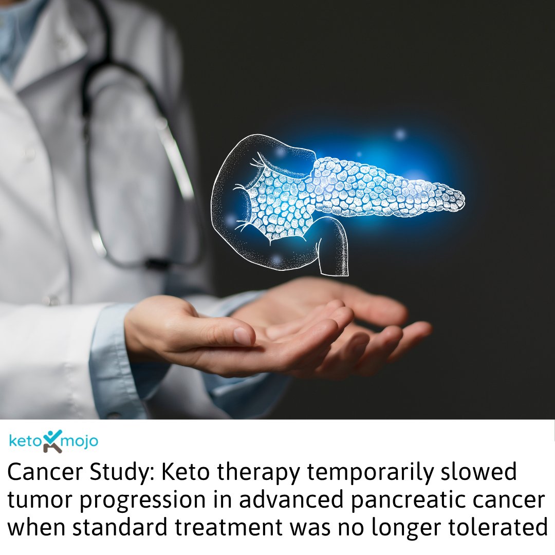 KetoMojo's tweet photo. This case report describes the experience of a 60-year-old woman with recurrent pancreatic ductal adenocarcinoma (PDAC) who stabilized her disease for 9 months using a ketogenic diet after declining further chemotherapy due to side effects. PDAC has a poor prognosis, and survival after recurrence is typically less than 1 year. 

After initial chemotherapy and surgery, she completed additional chemotherapy and radiotherapy for lung metastases. When the cancer progressed again, she began a strict ketogenic diet (<50 g carbohydrates, high fat with medium-chain triglycerides), with meals supervised by a dietitian for 3 months. Urine ketones were monitored daily. 

Key outcomes: 

🔹Disease remained stable for 9 months on the ketogenic diet alone; lung metastases showed minimal size change. 

🔹 Tumor marker (CA19-9) levels remained steady. 

🔹 The diet was well tolerated, with no reports of hunger, hair loss, or other side effects.  

🔹 Disease progressed at 12 months, at which point chemotherapy was reintroduced. 

🔹 The patient lived 24 months after starting the diet. 

🔹 The tumor showed high GLUT-1 expression, suggesting sensitivity to glucose restriction.

This case highlights the potential role of ketogenic therapy in select patients with pancreatic cancer, although more research is needed. 

—

Einama T, Yonamine N, Hatakeyama M, Ogata S, Kobayashi K, Shinada H, Tsunenari T, Takihata Y, Takao M, Ueno H, Kishi Y. Postoperative recurrence of pancreatic cancer controlled for 9 months solely by severe carbohydrate restriction: ketogenic diet. Clin J Gastroenterol. 2025.  

📌  Link to study: https://t.co/20Gf6zbqHM   

📌 Find more research summaries on our website: https://t.co/iJavUH3WTx

#KetogenicDiet #Oncology #PancreaticCancer #Research