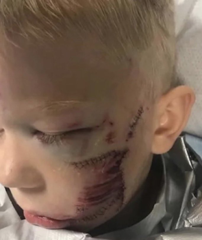 Arisha2ru's tweet photo. This 6 year old boy threw himself in front of a vicious dog to save his little sister❤️😭 https://t.co/wQMEuum4uE