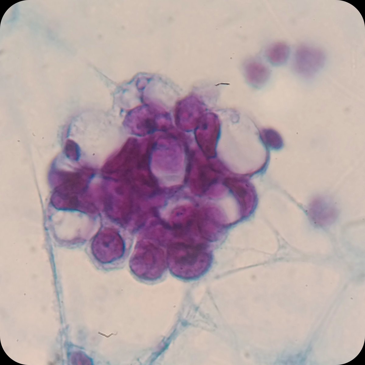 duckhuca's tweet photo. 🔙 To work.
♀️ Ascitis.
💉 Paracentesis.
🔬 Metastatic Carcinoma.  Category 5, The International System for Reporting Serous Fluid Cytopathology.
📊 Compare the cells you are familiar with (lymphocytes or mesothelial cells) to the cell in question.

#Cytology #CytoPath https://t.co/oFmRjigoxe