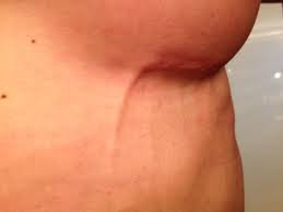 HansCollin2's tweet photo. Jueves de educación médica.

Lourdes, 32, presenta una especie de “cordón fibroso” subcutáneo, debajo del seno izquierdo, de ~5 cm de largo, ~0.5 cm de ancho y sin datos de eritema.

Es doloroso al tacto y apareció de un momento a otro.

¿Diagnóstico?
🧵
https://t.co/k3IZ69EHNP https://t.co/NnPnTWFctd