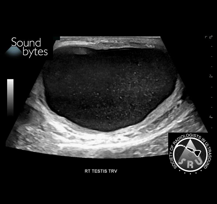 sruradiology's tweet photo. 77M with increasing right scrotal swelling. What's your sound diagnosis (of the epididymal finding)?
Case courtesy of Michael Weintraub, MD, MassGeneral Brigham
#RadResidents #ultrasound #RadInTraining https://t.co/dE5wrsPRdP