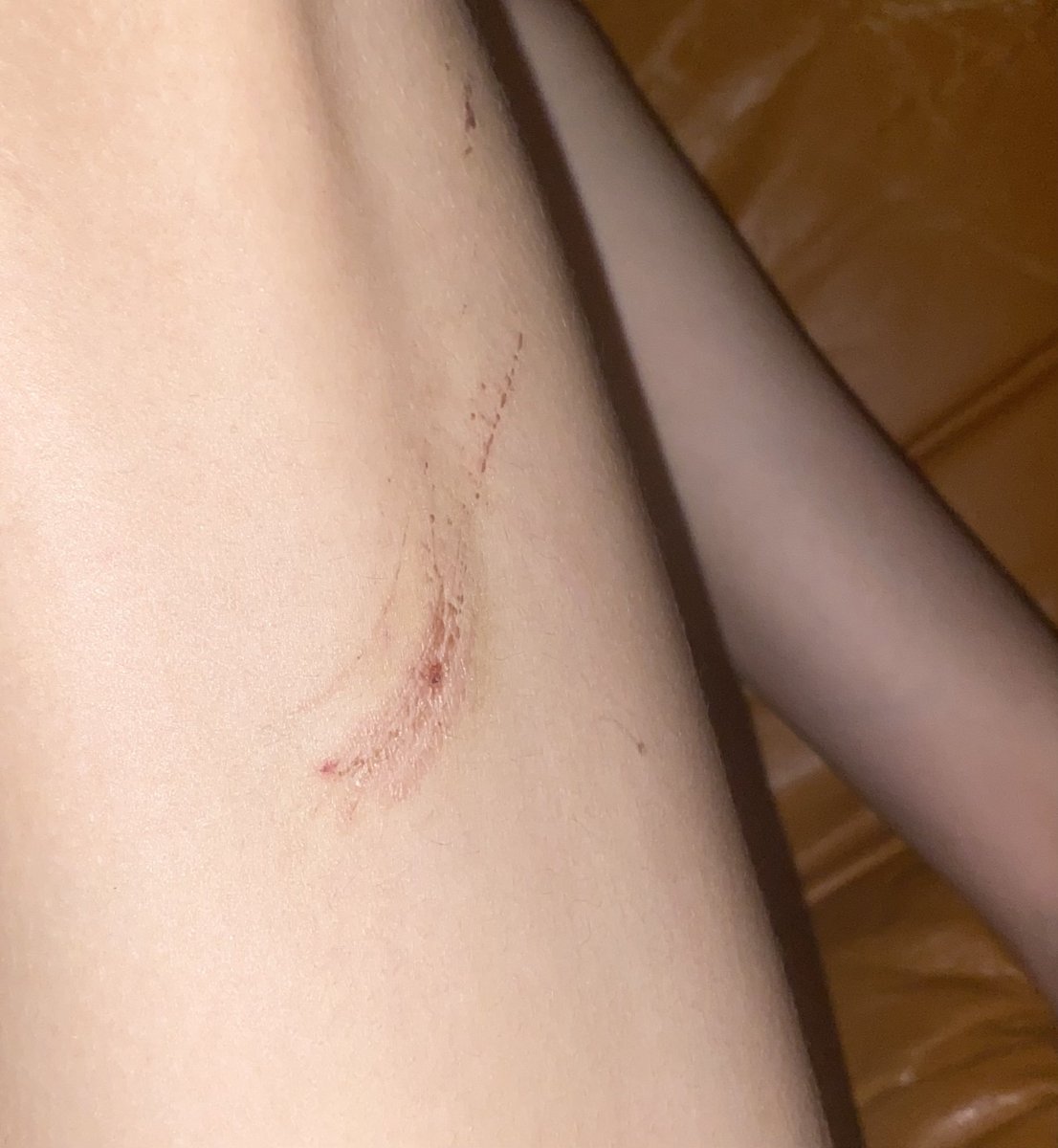 LesbophobiaRCPT's tweet photo. A lesbian asylum seeker was a victim of police brutality last week in Italy.
She was attacked by 3 men completely unprovoked just for being a masculine lesbian!

Please share, read the article below about the case, donate to help her move to a safer location and get treatment https://t.co/aXhbW7tvb0