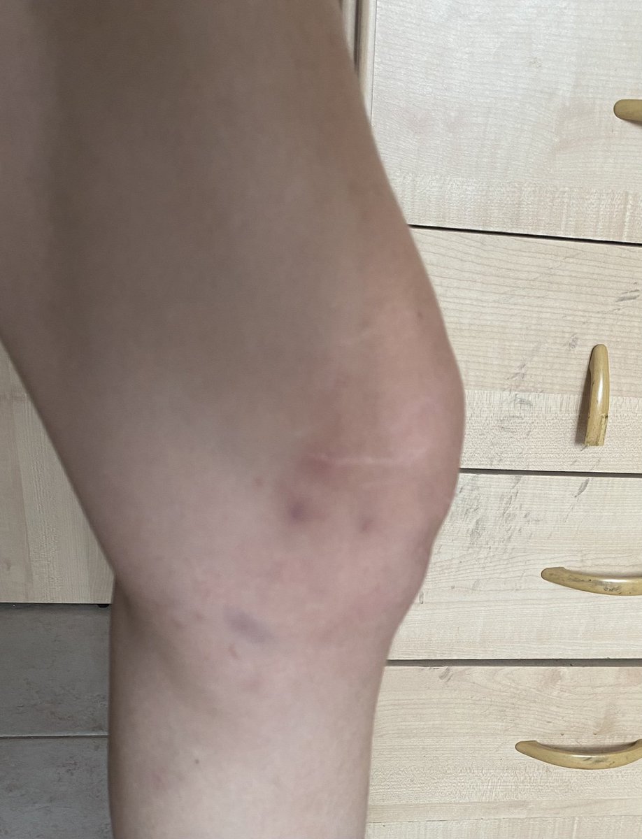 LesbophobiaRCPT's tweet photo. A lesbian asylum seeker was a victim of police brutality last week in Italy.
She was attacked by 3 men completely unprovoked just for being a masculine lesbian!

Please share, read the article below about the case, donate to help her move to a safer location and get treatment https://t.co/aXhbW7tvb0