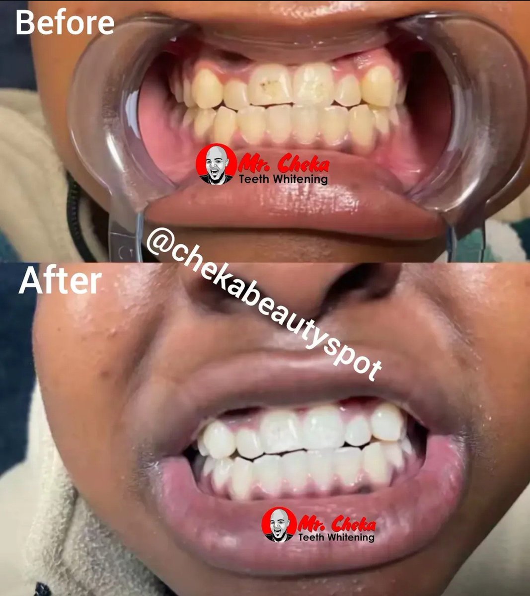 chekabeautyspot's tweet photo. Dawa yetu ya Kusafisha Meno ni nzuri na ya Uhakika... na inapatikana cheka beauty spot pekee..(ARUSHA, DAR ES SALAAM, DODOMA NA MWANZA)

Weka oda Yako Sasa tukutumie popote ulipo kwa uaminifu mkubwa.. karibu tukuhudumie.. https://t.co/VoipxG7og5