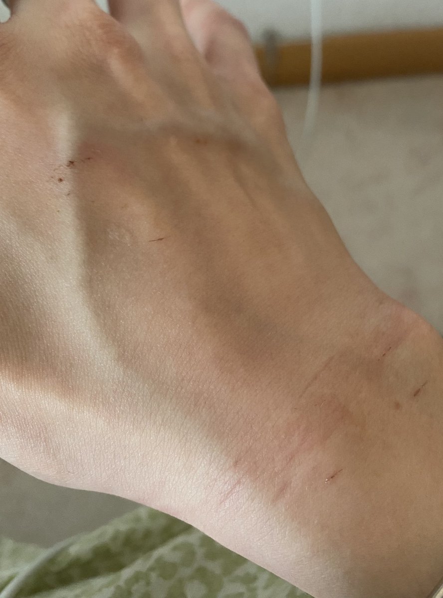 LesbophobiaRCPT's tweet photo. A lesbian asylum seeker was a victim of police brutality last week in Italy.
She was attacked by 3 men completely unprovoked just for being a masculine lesbian!

Please share, read the article below about the case, donate to help her move to a safer location and get treatment https://t.co/aXhbW7tvb0