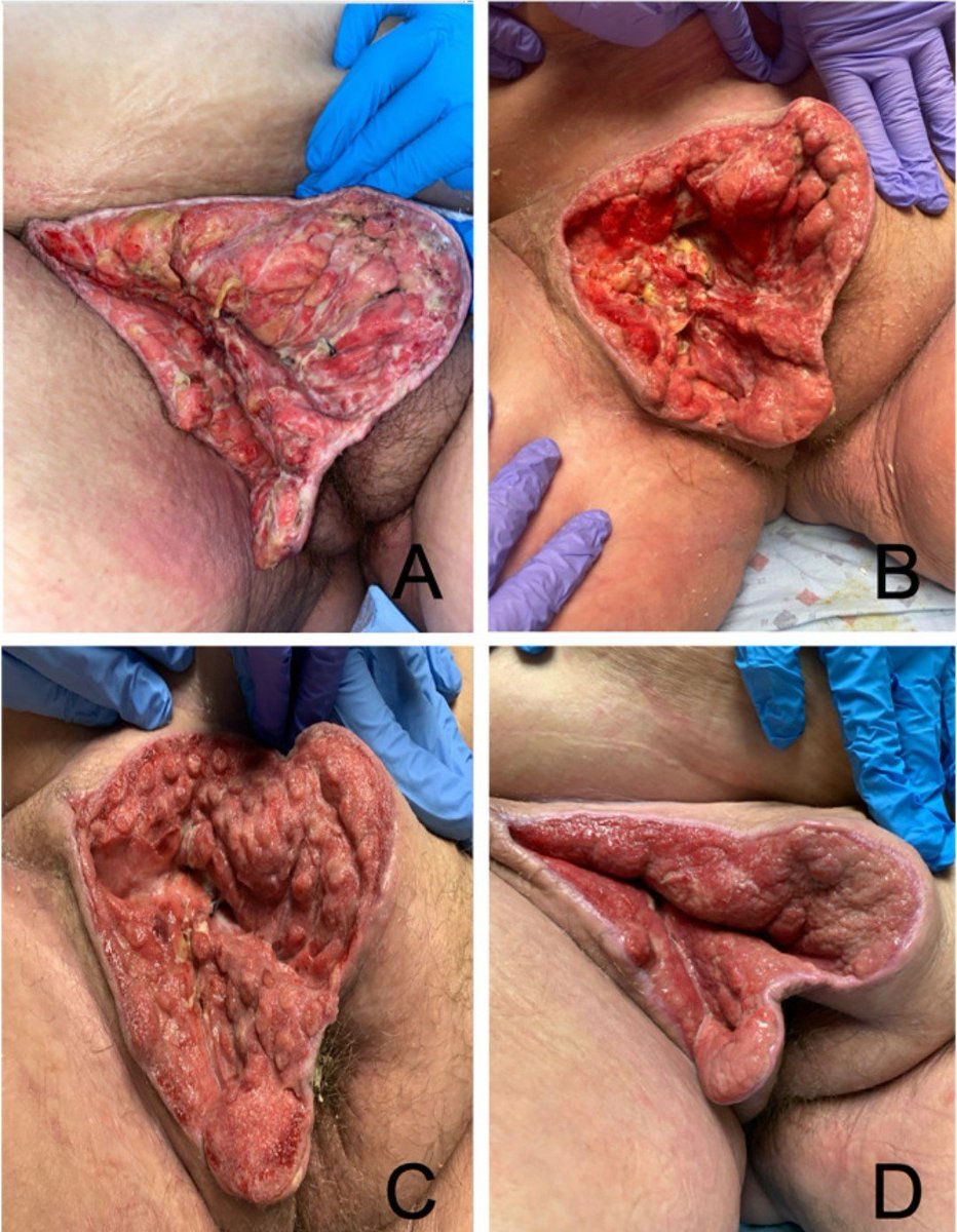 A7qlj7's tweet photo. @Jarmyjarmer @dawnmidnightt How about a two for one? Here is someone who will never be a woman but desperately wants to emulate one through surgery, only to have their inside out dick meat turn green. https://t.co/eqQq2PzlwK